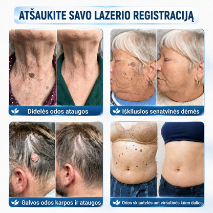 👩‍⚕️💯 Oficiální obchod | MURWON® 🌥️ Mikrojehličková náplast pro odstranění kožních nedokonalostí (Pro kožní výrůstky, drobné kožní útvary, bradavice, mateřská znaménka, stařecké skvrny a pigmentové nepravidelnosti.)🐮