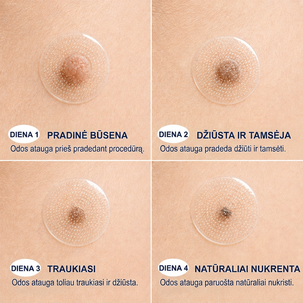 👩‍⚕️💯 Oficiální obchod | MURWON® 🌥️ Mikrojehličková náplast pro odstranění kožních nedokonalostí (Pro kožní výrůstky, drobné kožní útvary, bradavice, mateřská znaménka, stařecké skvrny a pigmentové nepravidelnosti.)🐮