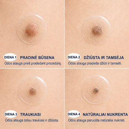 👩‍⚕️💯 Oficiální obchod | MURWON® 🌥️ Mikrojehličková náplast pro odstranění kožních nedokonalostí (Pro kožní výrůstky, drobné kožní útvary, bradavice, mateřská znaménka, stařecké skvrny a pigmentové nepravidelnosti.)🐮
