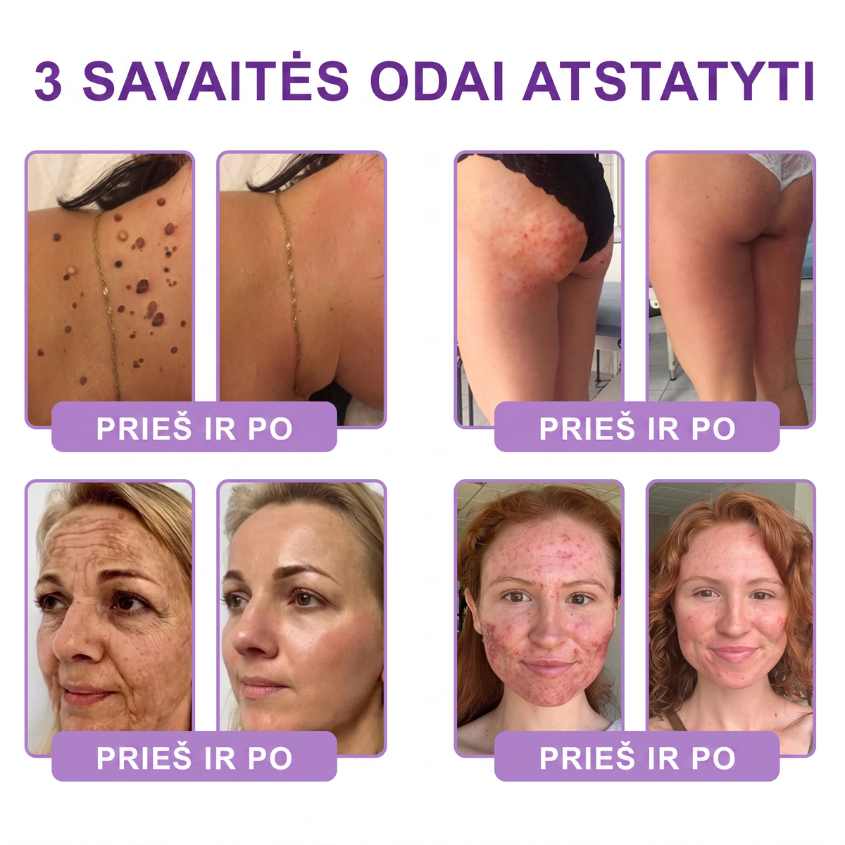 Ekspertų rekomenduojama🥦 |🌥️Vitalisys® PDRN“daugiapeptidis masažuojamasis kūno kremas – Anti-senėjimo, drėkinamasis,stangrinamasis,odą regeneruojantis,sulyginantis,spuogų ir dėmių šalinimo,karpų ir apgamų šalinimo, psoriazės palengvinimo priemonė.💙