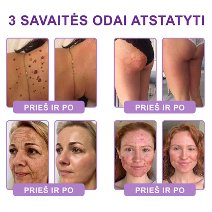 Ekspertų rekomenduojama🥦 |🌥️Vitalisys® PDRN“daugiapeptidis masažuojamasis kūno kremas – Anti-senėjimo, drėkinamasis,stangrinamasis,odą regeneruojantis,sulyginantis,spuogų ir dėmių šalinimo,karpų ir apgamų šalinimo, psoriazės palengvinimo priemonė.💙