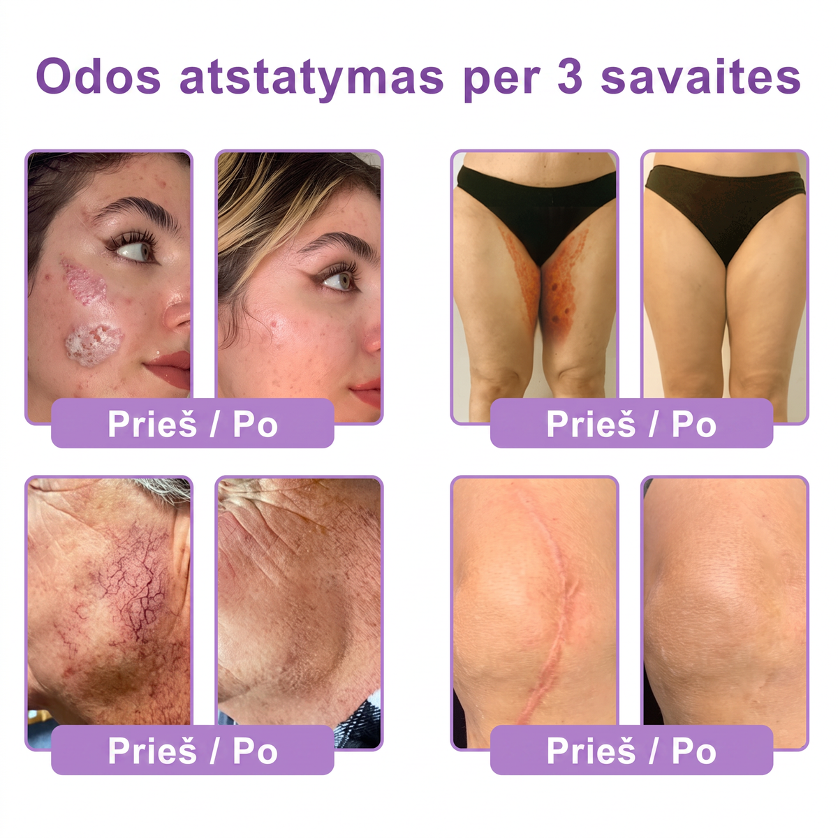Ekspertų rekomenduojama🥦 |🌥️Vitalisys® PDRN“daugiapeptidis masažuojamasis kūno kremas – Anti-senėjimo, drėkinamasis,stangrinamasis,odą regeneruojantis,sulyginantis,spuogų ir dėmių šalinimo,karpų ir apgamų šalinimo, psoriazės palengvinimo priemonė.💙